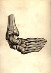 [Talipes equinovarus (club foot)]